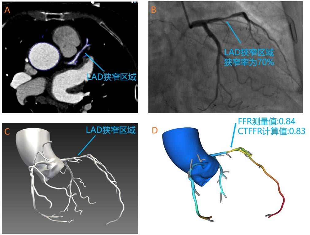 奧泰康助力睿心醫(yī)療&mdash;《冠狀動脈供血功能（CT-FFR）評估軟件》產品完成創(chuàng)新審評及臨床試驗