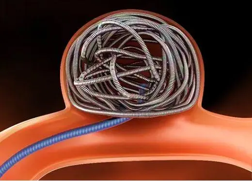  MA市場(chǎng)準(zhǔn)入 | 神經(jīng)介入②顱內(nèi)彈簧圈系統(tǒng)-臨床評(píng)價(jià)路徑