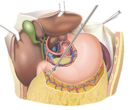 前研 | 外科止血超聲刀類(lèi)產(chǎn)品臨床及注冊(cè)